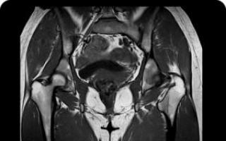 MRI of the pelvis with contrast